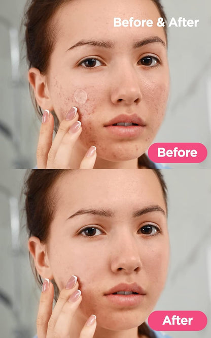 A-CLEAR SOOTHING ACNE CARE (1 PACK)